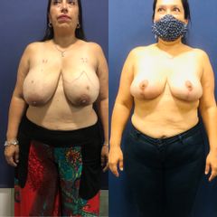 Reducción mamaria - Clínica Medystetic