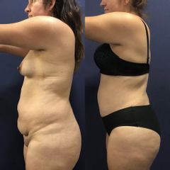 Abdominoplastia - Clínica Medystetic