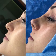 Rinoplastia - Clínica Medystetic