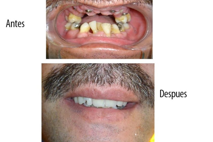 Implantes dentales antes y después - 575358