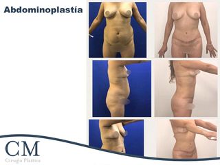 Abdominoplastia