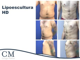 Lipoescultura HD