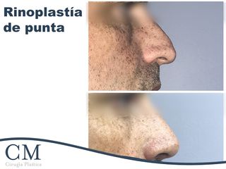 Rinoplastia de punta