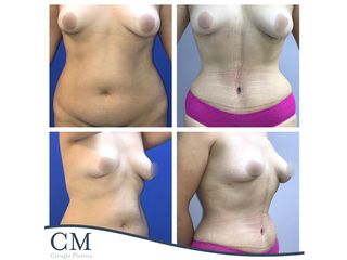 Lipo Abdominoplastia