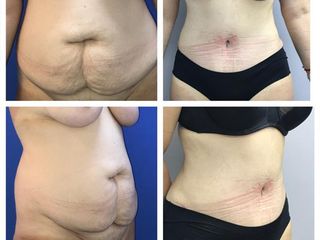 Lipo abdominplastia