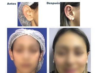 Otoplastia - 641554
