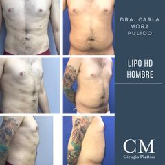 Lipo hd hombre