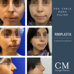 Rinoplastia