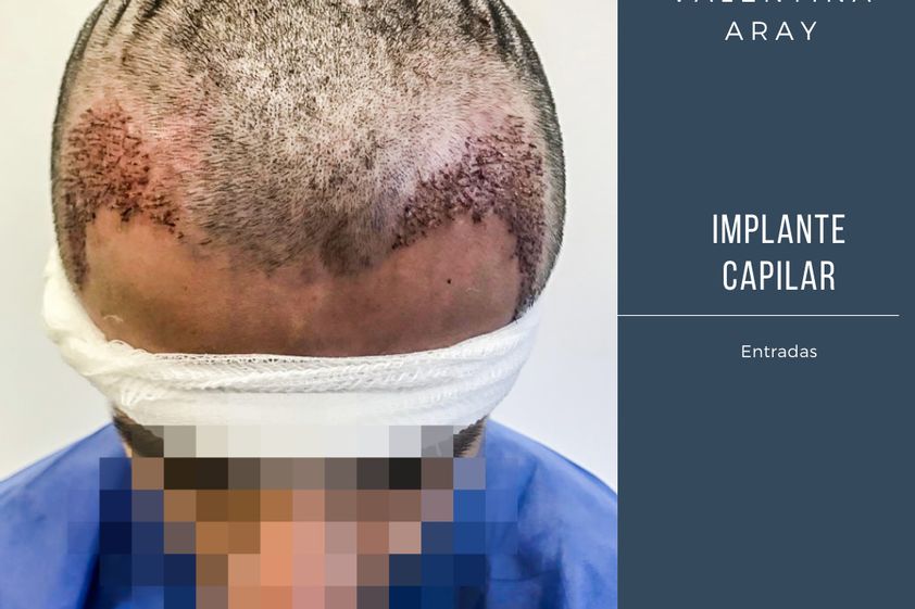 Alopecia antes y después - 693728