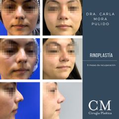 Rinoplastia 6 mese de recuperación