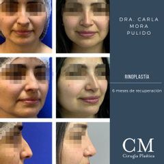 Rinoplastía - Dra. Carla Mora Pulido.