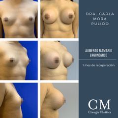 Aumento mamario - Dra. Carla Mora Pulido.