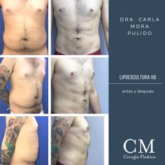Lipoescultura HD