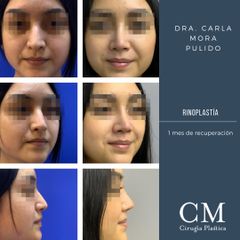 Rinoplastia - Dra. Carla Mora Pulido