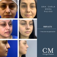 Rinoplastia - Dra. Carla Mora Pulido