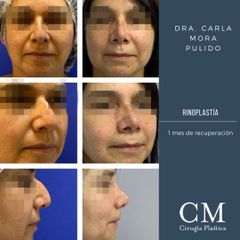 Rinoplastía - Dra. Carla Mora Pulido