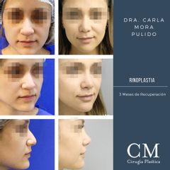 Rinoplastia 3 meses de recuperación