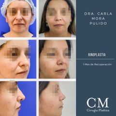 Rinoplastia - Dra. Carla Mora Pulido