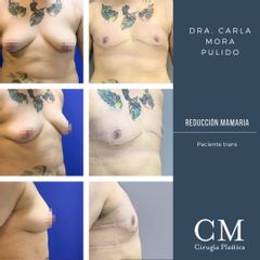 Reducción mamaria - Dra. Carla Mora Pulido
