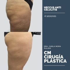 Heccus anti celulitis Dra. Carla Mora Pulido