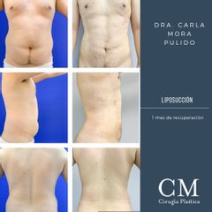 Liposucción - Dra. Carla Mora Pulido