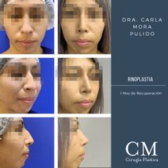 Rinoplastia - Dra. Carla Mora Pulido