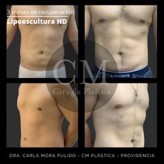 Lipo HD - Dra. Carla Mora Pulido