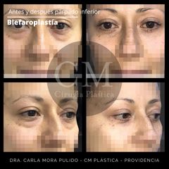 Blefaroplastía parpado inferior - Dra. Carla Mora Pulido