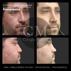 Rinoplastia - Dra. Carla Mora Pulido