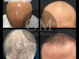 Alopecia - 795951