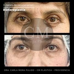 Blefaroplastia - Dra. Carla Mora Pulido