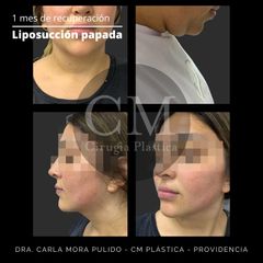 Liposucción papada - Dra. Carla Mora Pulido