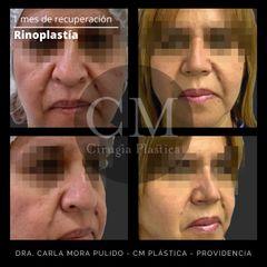 Rinoplastía - Dra. Carla Mora Pulido