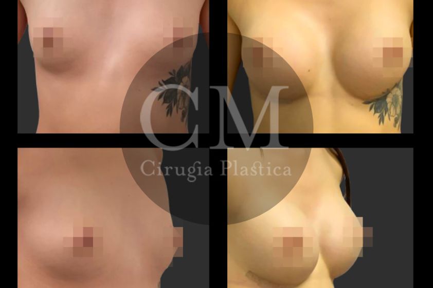 Reasignación de sexo antes y después - 819252