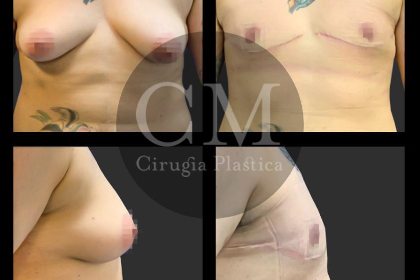 Reasignación de sexo antes y después - 819624