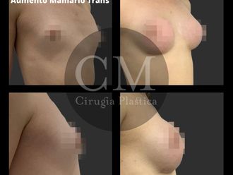 Reasignación de sexo antes y después - 819625