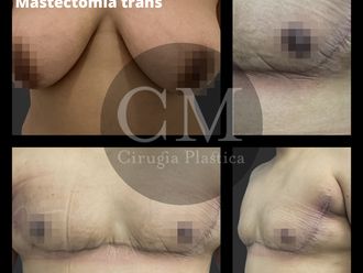 Reasignación de sexo antes y después - 819962