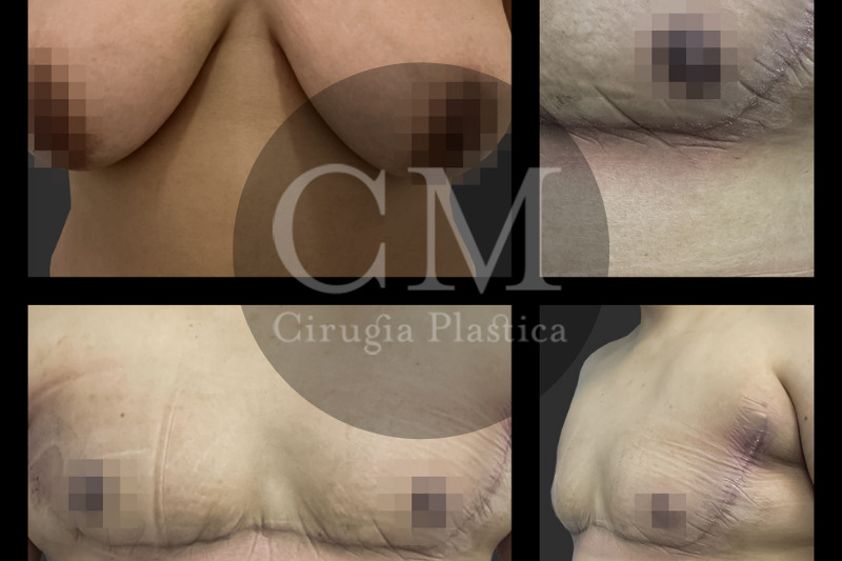 Reasignación de sexo antes y después - 819962