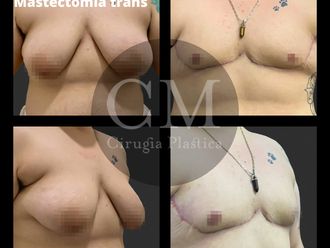 Reasignación de sexo antes y después - 820886