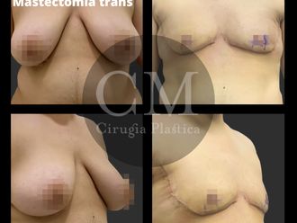 Reasignación de sexo antes y después - 821372