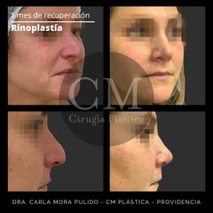 Rinoplastía - Dra. Carla Mora Pulido