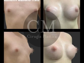 Reasignación de sexo antes y después - 826373