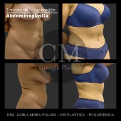 Abdominoplastía - Dra. Carla Mora Pulido