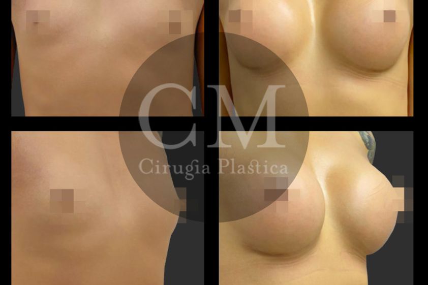 Reasignación de sexo antes y después - 839779