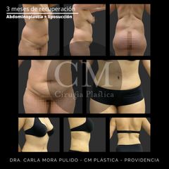 Abdominoplastía + liposucción - Dra. Carla Mora Pulido