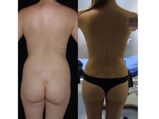 aumento mamario con una mini lipo