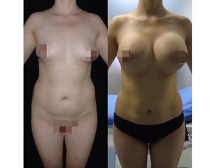 aumento mamario con una mini lipo