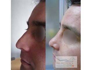 Rinoplastias Clinica Primaestetica