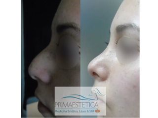 Rinoplastias Clinica Primaestetica