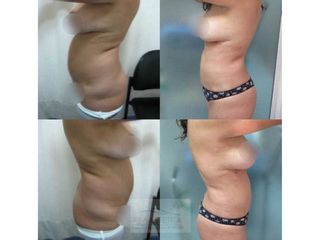 Pexia con implantes
